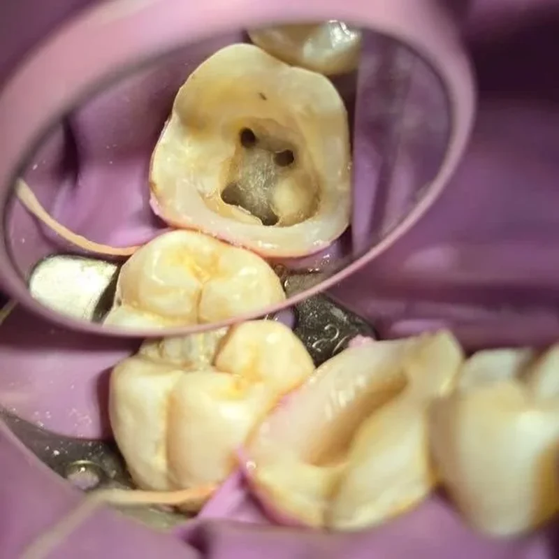 Avaliação de dente com cárie avançada no Prado, Belo Horizonte, Dentistas BH